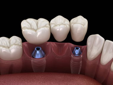 Diş köprüsü implantlarla destekleniyor. İnsan dişleri ve protez kavramının tıbben doğru üç boyutlu çizimi