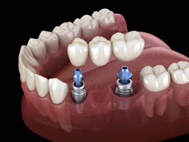 Diş köprüsü implantlarla destekleniyor. İnsan dişleri ve protez kavramının tıbben doğru üç boyutlu çizimi