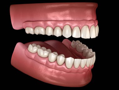 Çikletli Maxillary ve Mandibular protez hepsi de implantlarla desteklenen 4 sistemde. İnsan dişlerinin ve protezlerinin tıbbi açıdan doğru üç boyutlu çizimi