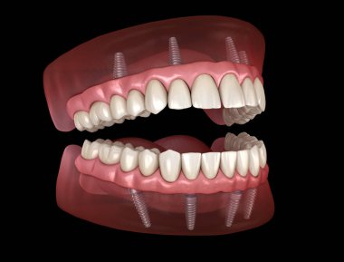 Maxillary and Mandibular prosthesis with gum All on 4 system supported by implants. Medically accurate 3D illustration of human teeth and dentures clipart