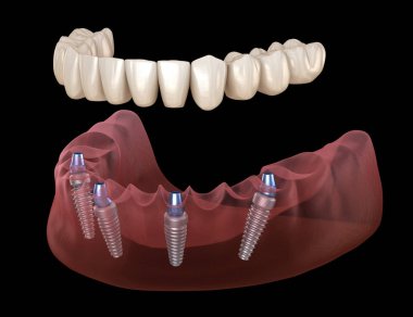 Alt çene protezi. Hepsi de implantlarla desteklenen 4 sistemde. İnsan dişleri ve protez kavramının tıbben doğru üç boyutlu çizimi