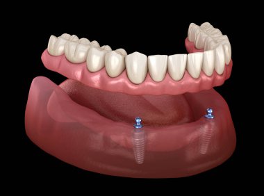 Mandibular removable prosthesis All on 2 system supported by implants with ball attachments. Medically accurate dental 3D illustration clipart