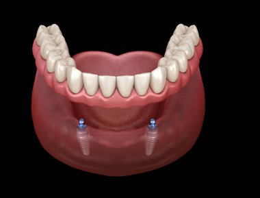 Alt çene çıkarılabilir protez. Hepsi top eklentili implantlar tarafından desteklenen 2 sistemde. Tıbbi olarak doğru olan 3 boyutlu diş illüstrasyonu