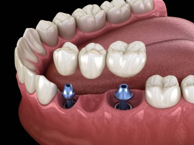 Diş köprüsü implantlarla destekleniyor. İnsan dişleri ve protez kavramının tıbben doğru üç boyutlu çizimi