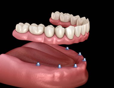 Çikletli çene protezi. Hepsi de implantlarla desteklenen 6 sistemde. İnsan dişleri ve protez kavramının tıbben doğru üç boyutlu çizimi