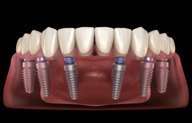 Çene protezi. Hepsi de implantlarla desteklenen 6 sistemde. İnsan dişleri ve protez kavramının tıbben doğru üç boyutlu çizimi