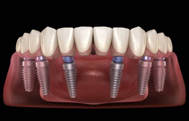 Mandibular prosthesis All on 6 system supported by implants. Medically accurate 3D illustration of human teeth and dentures concept clipart