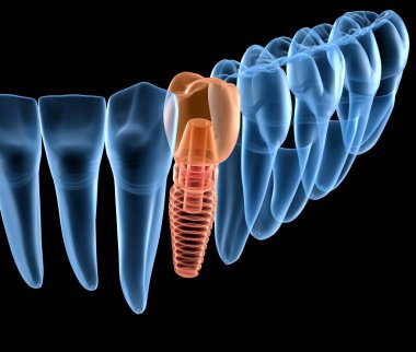 İmplant ile premolar diş kurtarma, x-Ray görünümü. İnsan dişleri ve protezkavramının tıbbi olarak doğru 3d illüstrasyon