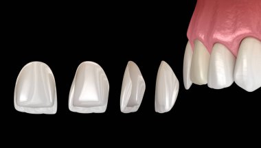 Merkezi kesici diş ve yan kesici diş üzerinde vener kurulum prosedürü. Tıbbi olarak doğru diş 3D illüstrasyon