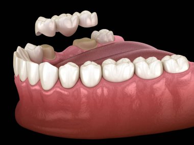 Dental bridge of 3 teeth over molar and premolar. Medically accurate 3D illustration of human teeth treatment clipart