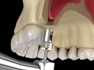 Sinüs Lift Cerrahisi - Sinüs bir erişim oluşturma. 3d illüstrasyon