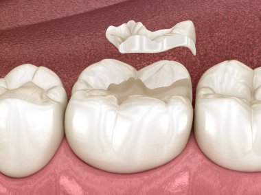 Dişe seramik taç takın. İnsan diş tedavisinin tıbbi açıdan doğru üç boyutlu çizimi