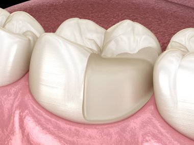 Diş üzerinde Onlay seramik taç fiksasyon. İnsan diş tedavisi tıbbi olarak doğru 3d illüstrasyon