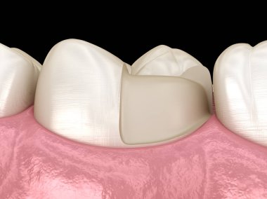 Diş üzerinde Onlay seramik taç fiksasyon. İnsan diş tedavisi tıbbi olarak doğru 3d illüstrasyon