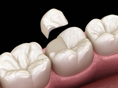Diş üzerinde Onlay seramik taç fiksasyon. İnsan diş tedavisi tıbbi olarak doğru 3d illüstrasyon