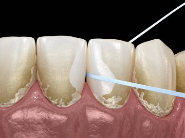 Ağız hijyeni: plak çıkarma için diş ipi kullanarak. Tıbbi olarak doğru diş 3d illüstrasyon