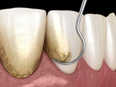 Ağız temizliği: Ölçekleme ve kök planlama (geleneksel periodontal terapi). İnsan diş tedavisinin tıbbi açıdan doğru üç boyutlu çizimi