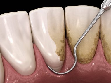 Ağız temizliği: Ölçekleme ve kök planlama (geleneksel periodontal terapi). İnsan diş tedavisinin tıbbi açıdan doğru üç boyutlu çizimi