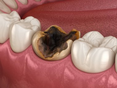 Azı dişleri bakirelerden zarar görmüş. Tıbbi olarak doğru diş 3D illüstrasyon.
