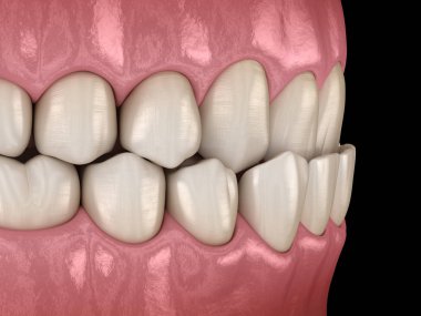 Underbite diş tıkanıklığı ( Dişlerin maloklüzyon ). Tıbbi olarak doğru diş 3d illüstrasyon