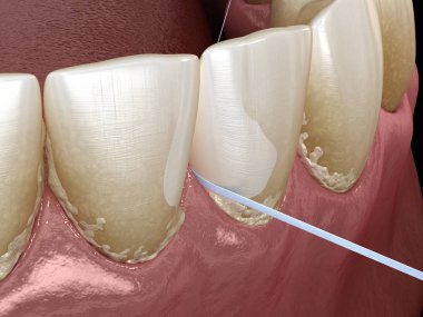 Ağız hijyeni: plak çıkarma için diş ipi kullanarak. Tıbbi olarak doğru diş 3d illüstrasyon