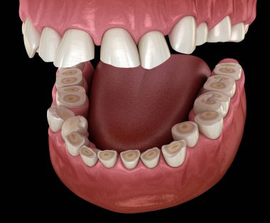 Diş çürümesi (Bruxism) diş dokusunun kaybıyla sonuçlanır. Tıbbi olarak doğru diş 3D illüstrasyon
