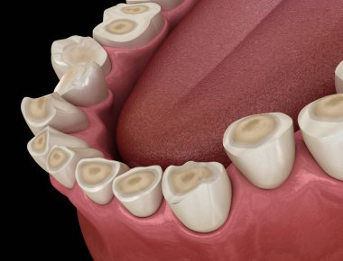 Diş çürümesi (Bruxism) diş dokusunun kaybıyla sonuçlanır. Tıbbi olarak doğru diş 3D illüstrasyon