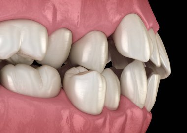 Anormal diş pozisyonu, ortodontik kavram. Tıbbi olarak doğru diş 3d illüstrasyon