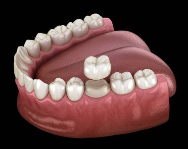 Diş kaplaması yerleştirme için hazırlanmış azı dişi. Tıbbi olarak doğru 3B illüstrasyon