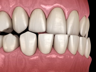 Underbite diş tıkanıklığı ( Dişlerin maloklüzyon ). Tıbbi olarak doğru diş 3d illüstrasyon
