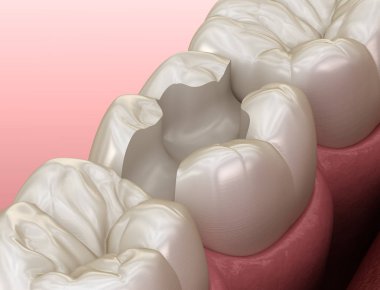 Kalıtm yerleştirme için diş hazırlığı. İnsan diş tedavisi tıbbi olarak doğru 3d illüstrasyon