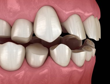 Diş çürümesi (Bruxism) diş dokusunun kaybıyla sonuçlanır. Tıbbi olarak doğru diş 3D illüstrasyon