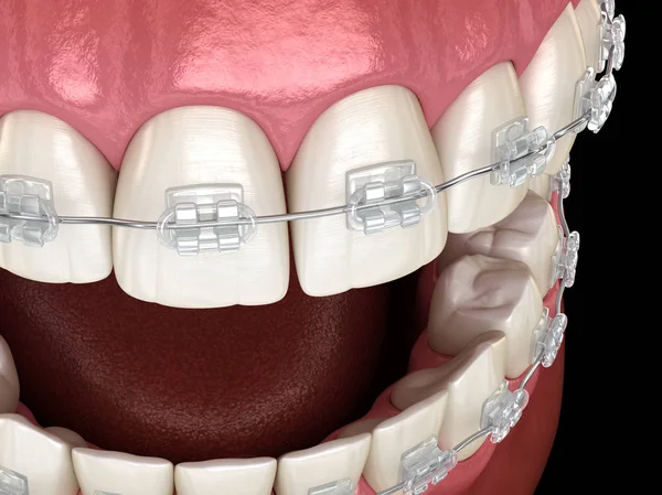 Dents Braces Claires Dans Les Gencives Illustration Dentaire Médicalement Précise — Photo