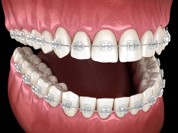Зубы Чистые Брекеты Деснах Медицинская Точность Иллюстрации — стоковое фото