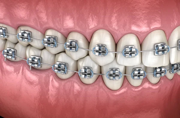 Denti Con Bretelle Metalliche Nelle Gengive Illustrazione Dentale Clinicamente Accurata — Foto Stock