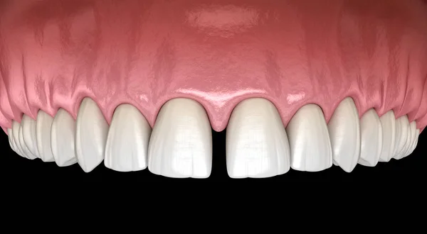 Διάσταση Των Δοντιών Των Κεντρικών Κοπτήρων Οδοντιατρική Δυσλειτουργία Εικόνα Έννοια — Φωτογραφία Αρχείου