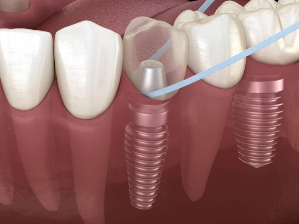 Implantat Zahnreinigung Mit Zahnseide Medizinisch Korrekte Illustration — Stockfoto