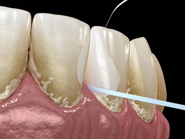 口腔卫生 使用牙线去除牙菌 医学上准确的牙科 — 图库照片