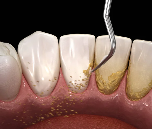 Mondhygiëne Ultrasone Tanden Reinigingsmachine Verwijderen Van Calculus Plaque Medisch Nauwkeurige — Stockfoto