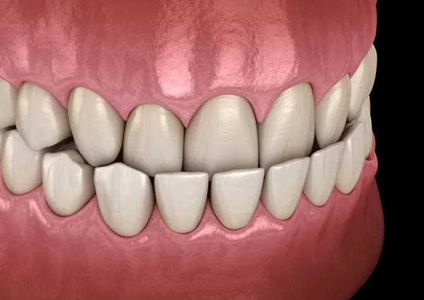 Oclusão Dentária Subdentária Oclusão Dos Dentes Ilustração Dente Medicamente Precisa — Fotografia de Stock