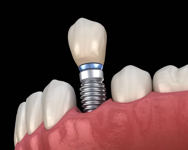 Premolar Tand Krona Installation Över Implantat Abutment Medicinskt Korrekt Illustration — Stockfoto