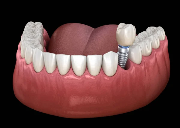 Przedtrzonowa Instalacja Korony Implancie Medycznie Dokładna Ilustracja Koncepcji Ludzkich Zębów — Zdjęcie stockowe