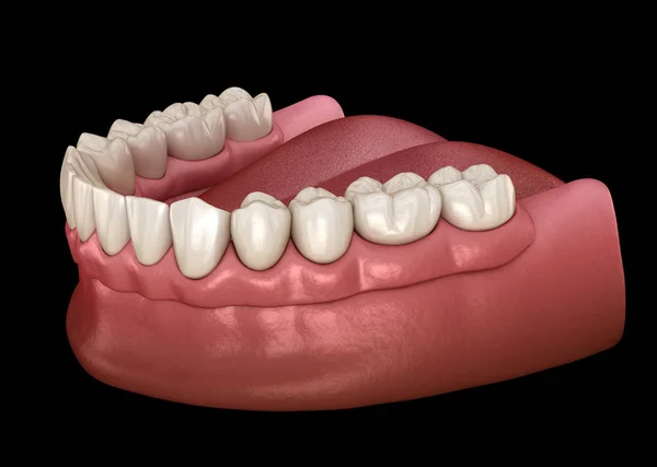 Mandibular Removable Prosthesis All System Supported Implants Medically Accurate Illustration — Stock Photo, Image