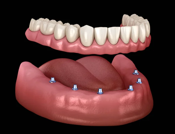 Mandibuláris Kivehető Protézis Mind Rendszer Által Támogatott Implantátumok Orvosilag Pontos — Stock Fotó