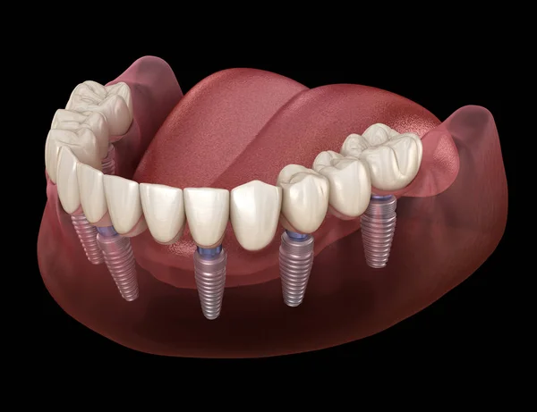 Prótesis Mandibular Todo Sistemas Soportado Por Implantes Ilustración Médicamente Precisa — Foto de Stock