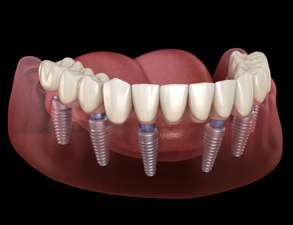 Мандибулярний Протез Системах Підтримується Імплантатами Медично Точна Ілюстрація Концепції Зубів — стокове фото