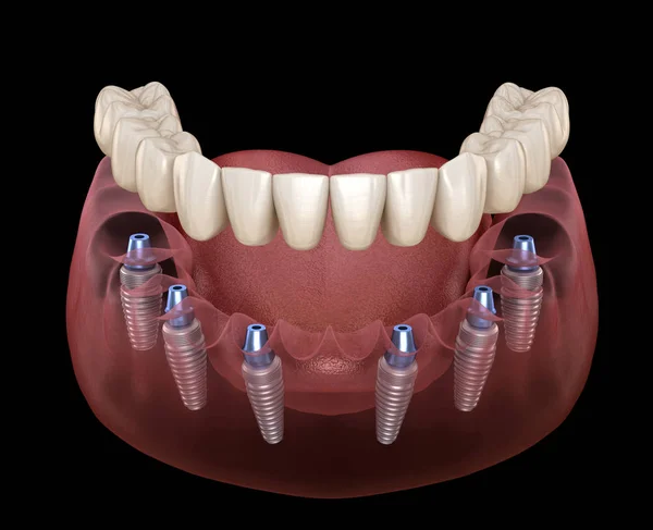 Prothèse Mandibulaire Tout Sur Système Soutenu Par Des Implants Illustration — Photo