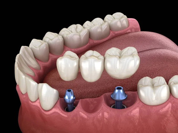 Diş köprüsü implantlarla destekleniyor. İnsan dişleri ve protez kavramının tıbben doğru üç boyutlu çizimi
