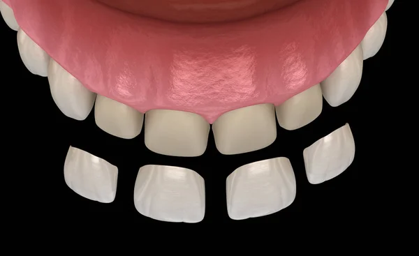 Procedimiento Instalación Chapa Sobre Incisivo Central Incisivo Lateral Ilustración Dientes — Foto de Stock