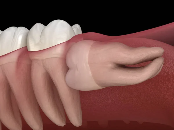 Dientes Sanos Muelas Del Juicio Con Impactación Mesial Ilustración Dientes — Foto de Stock